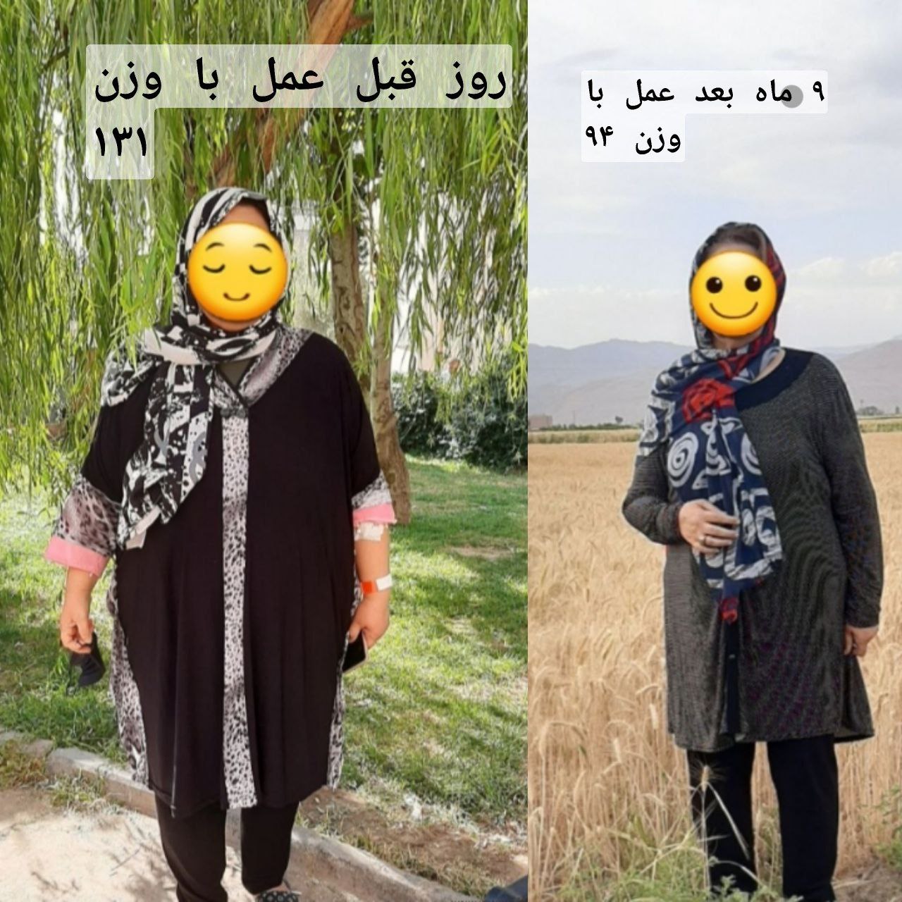 خانم - قبل از عمل با وزن 131 کیلوگرم و نه ماه بعد از عمل با وزن 94 کیلوگرم