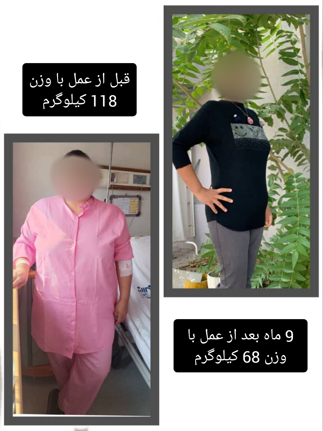 خانم - قبل از عمل با وزن 118 کیلوگرم - نه ماه بعد از عمل با وزن 68کیلوگرم