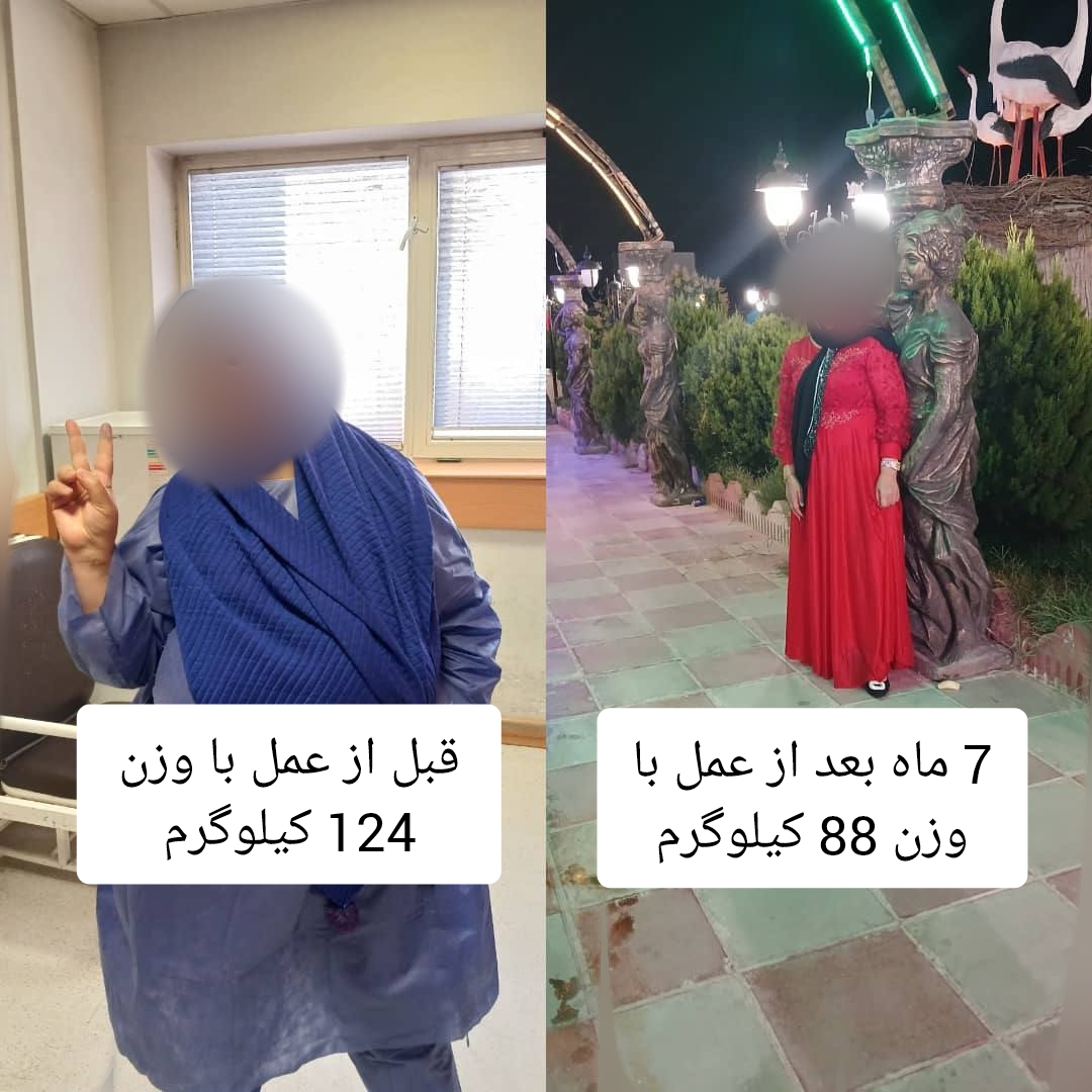 خانم - قبل از عمل با وزن 124 کیلوگرم - هفت ماه بعد از عمل با وزن 88 کیلوگرم