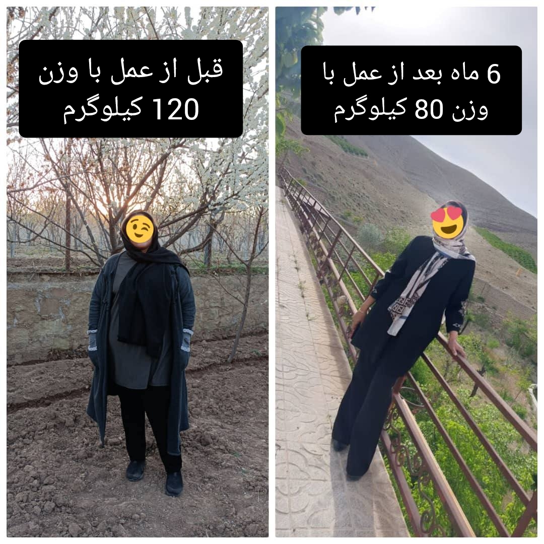 خانم - قبل از عمل با وزن 120 کیلوگرم - شش ماه بعد از عمل با وزن 80 کیلوگرم