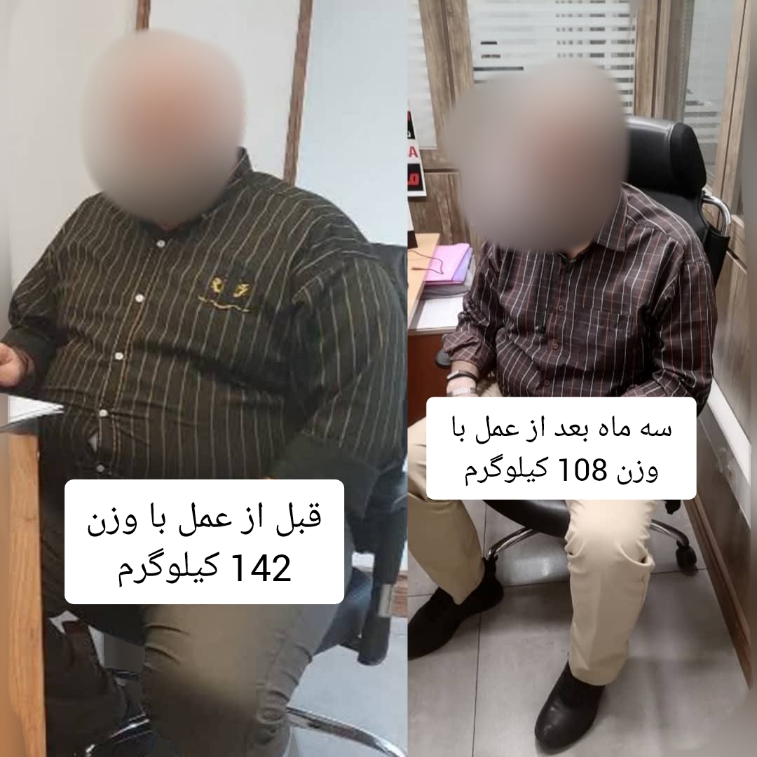اقا - قبل از عمل با وزن 142 کیلوگرم - سه ماه بعد از عمل با وزن 108 کیلوگرم