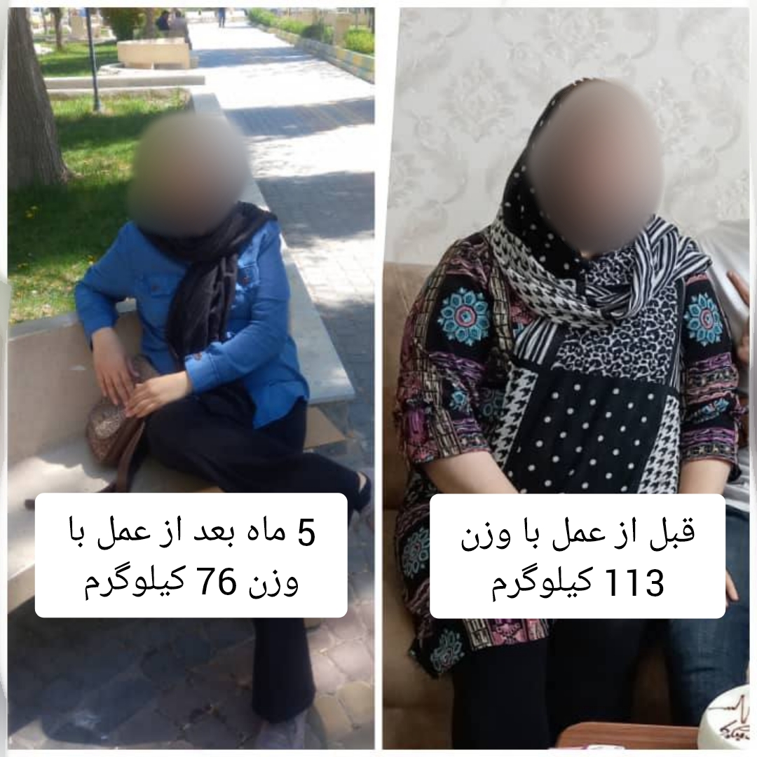 خانم - قبل از عمل با وزن 113 کیلوگرم - ئنج ماه بعد از عمل با وزن 76 کیلوگرم