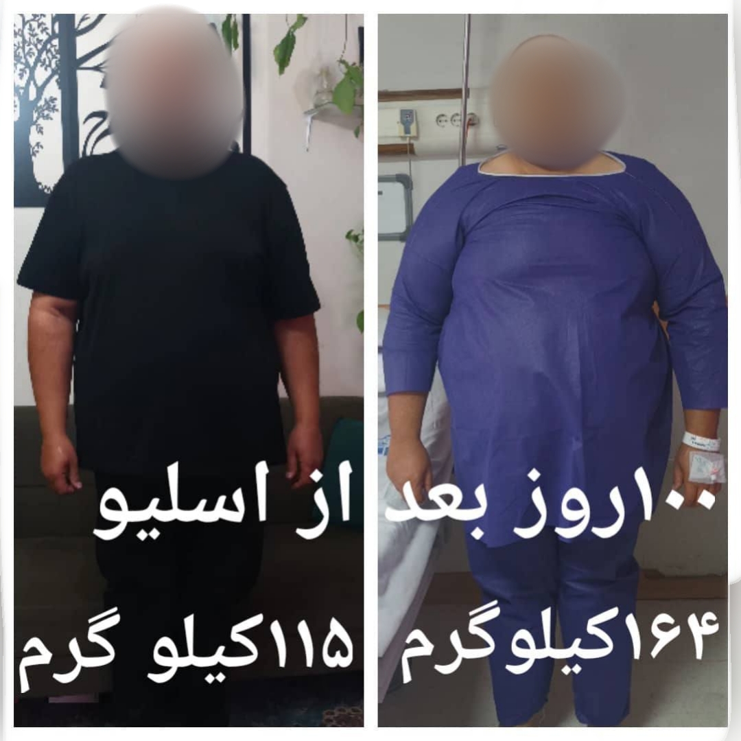 آقا - قبل از عمل با وزن 164 کیلوگرم - صد روز بعد از عمل با وزن 115 کیلوگرم