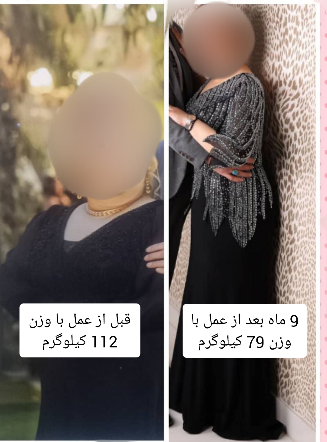خانم - قبل از عمل با وزن 112 کیلوگرم - نه ماه بعد از عمل با وزن 79 کیلوگرم