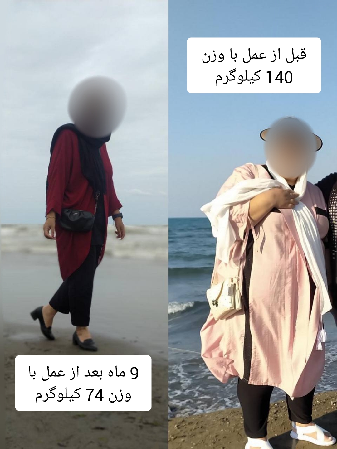خانم - قبل از عمل با وزن 140 کیلوگرم - نه ماه بعد از عمل با وزن 74 کیلوگرم