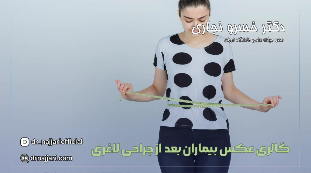 اسلیو معده