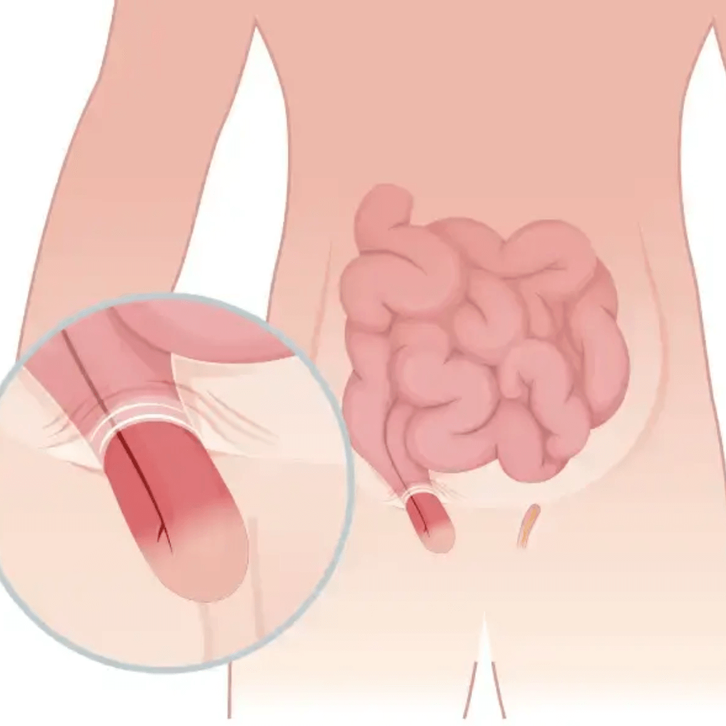 فتق اینگوینال