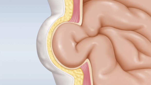 روش‌های اندازه‌گیری فتق