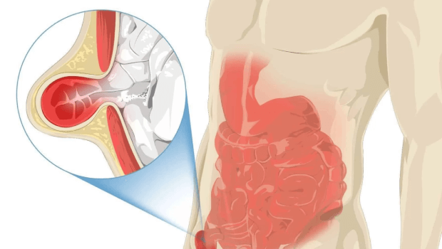 اندازه فتق برای عمل چقدر باید باشد؟