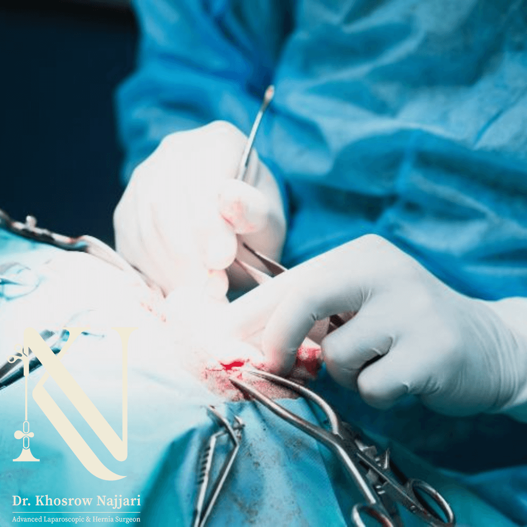 عوارض مش در عمل فتق