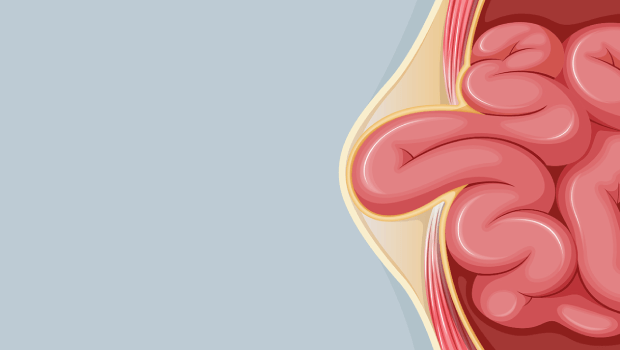 درد بعد از عمل فتق
