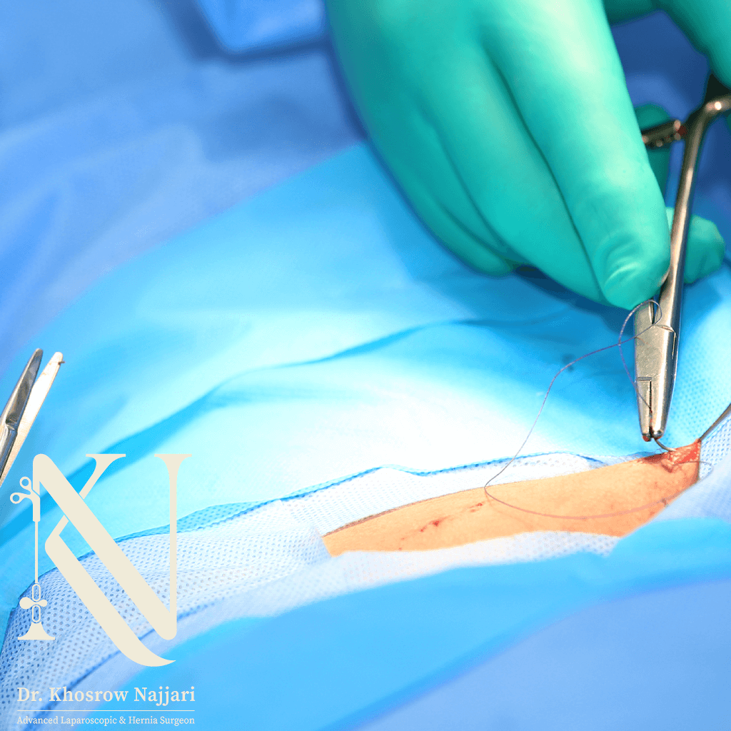 عمل فتق چند ساعت طول می‌کشد؟