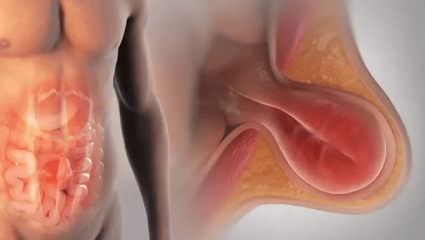 عمل فتق با مش چقدر طول می‌کشد